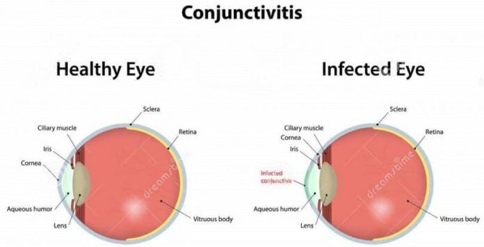 Conjunctivitis-eye